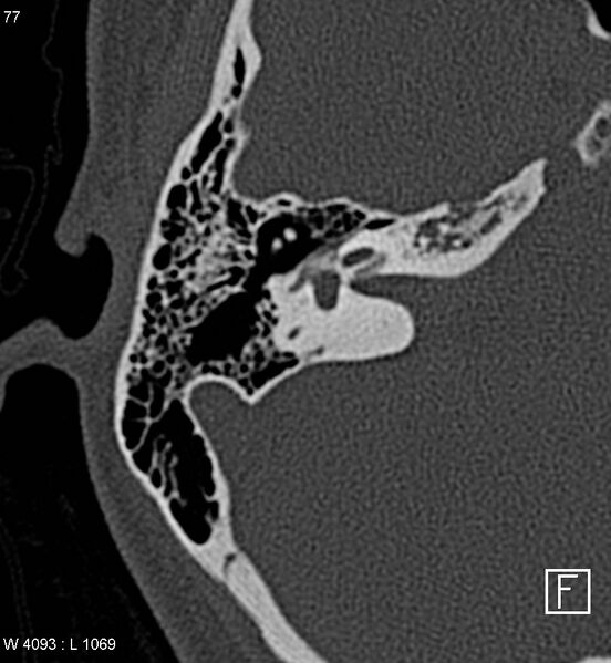 File:Bilateral otosclerosis with left stapes prosthesis (Radiopaedia 5567-7302 Axial bone window 10).jpg