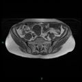 Bilateral ovarian fibroma (Radiopaedia 44568-48293 Axial T1 5).jpg