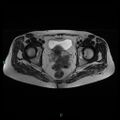 Bilateral ovarian fibroma (Radiopaedia 44568-48293 Axial T2 19).jpg