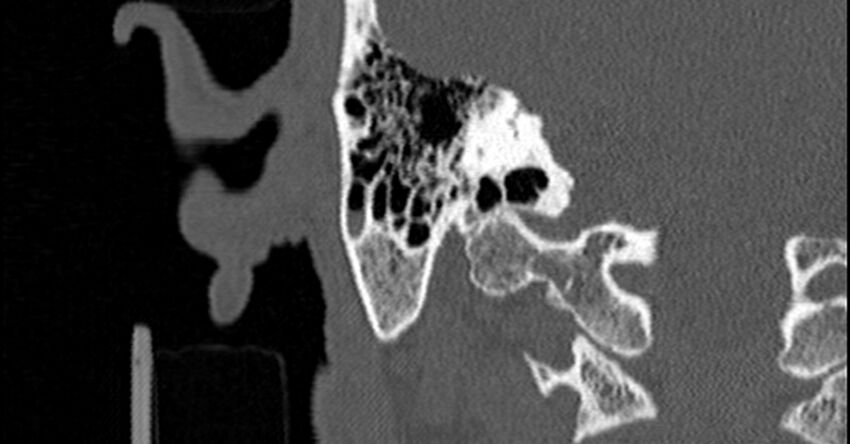 Bilateral temporal bone fractures (Radiopaedia 29482-29970 Coronal non-contrast 138).jpg