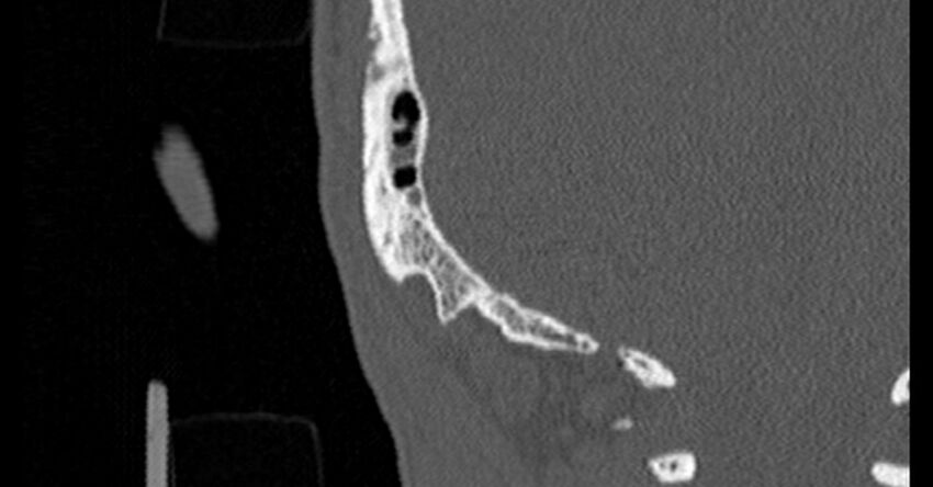 Bilateral temporal bone fractures (Radiopaedia 29482-29970 Coronal non-contrast 190).jpg