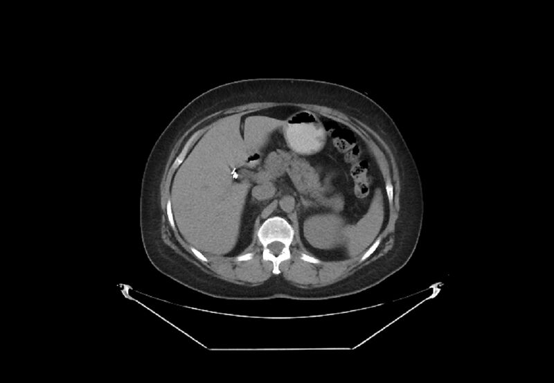 File:Bilateral urolithiasis with incidentally detected splenic artery aneurysm and left inferior vena cava (Radiopaedia 44467-48123 Axial non-contrast 13).jpg