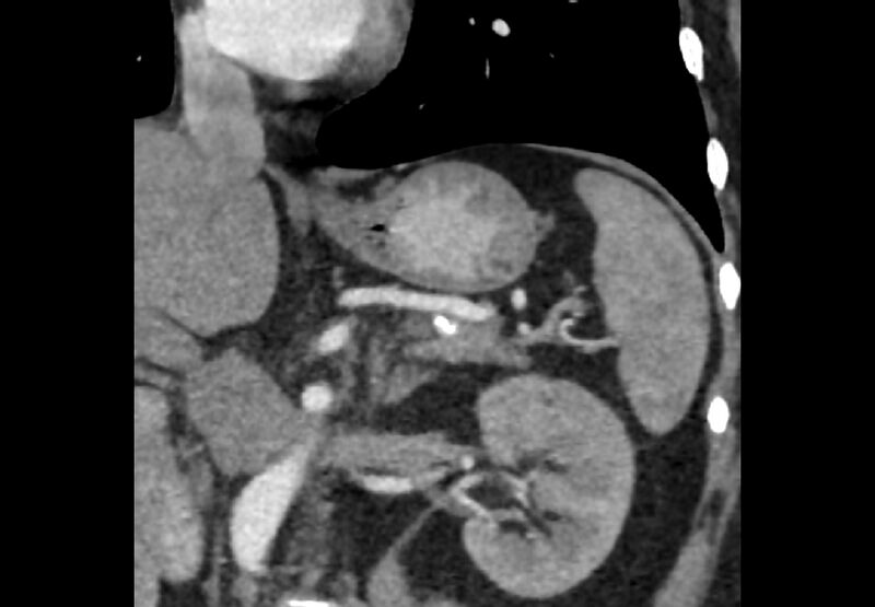 File:Bilateral urolithiasis with incidentally detected splenic artery aneurysm and left inferior vena cava (Radiopaedia 44467-48127 Ob. Cor. C+ Art. 19).jpg