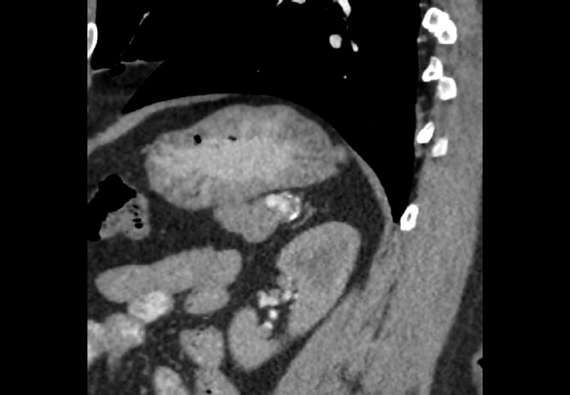 File:Bilateral urolithiasis with incidentally detected splenic artery aneurysm and left inferior vena cava (Radiopaedia 44467-48127 Ob. Sag. C+ Art. 20).jpg