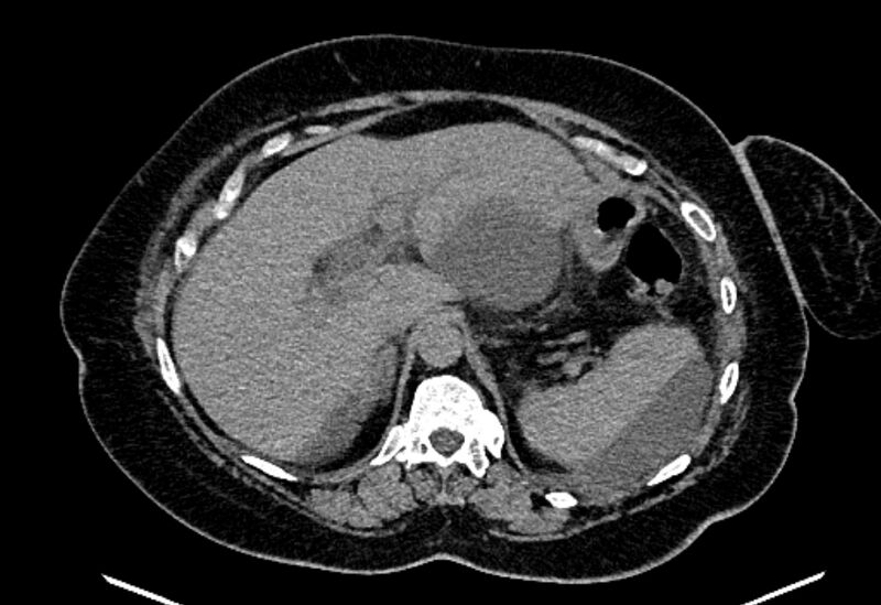 File:Biliary pancreatitis (Radiopaedia 72289-82823 Axial non-contrast 76).jpg
