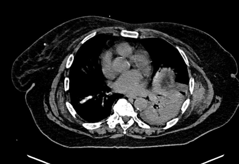 File:Biliary pancreatitis (Radiopaedia 72289-82823 Axial non-contrast 8).jpg