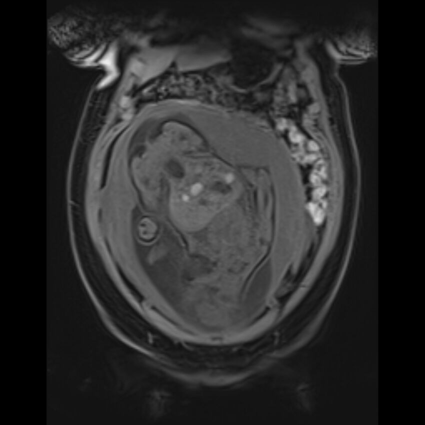 Bilobed placenta accreta (Radiopaedia 69648-79591 Coronal T1 vibe 47).jpg