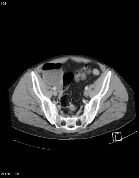File:Boerhaave syndrome with tension pneumothorax (Radiopaedia 56794-63603 A 54).jpg