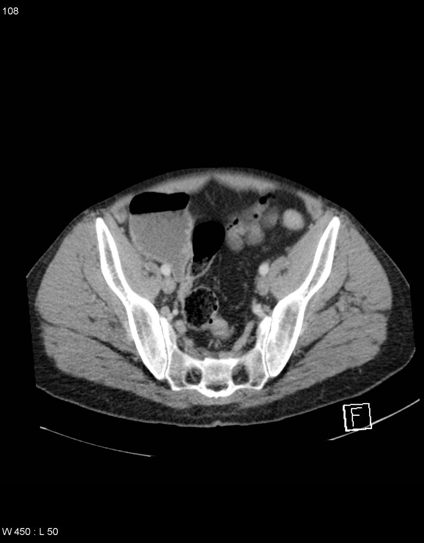 Boerhaave syndrome with tension pneumothorax (Radiopaedia 56794-63603 A 54).jpg