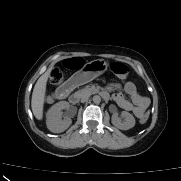 File:Bosniak renal cyst - type I (Radiopaedia 27479-27675 Axial non-contrast 35).jpg