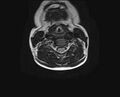 Brachial plexus birth palsy (Radiopaedia 68118-77604 Axial T2 10).jpg