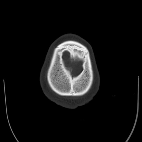 File:Brain Pantopaque remnants (Radiopaedia 78403-91048 Axial bone window 64).jpg
