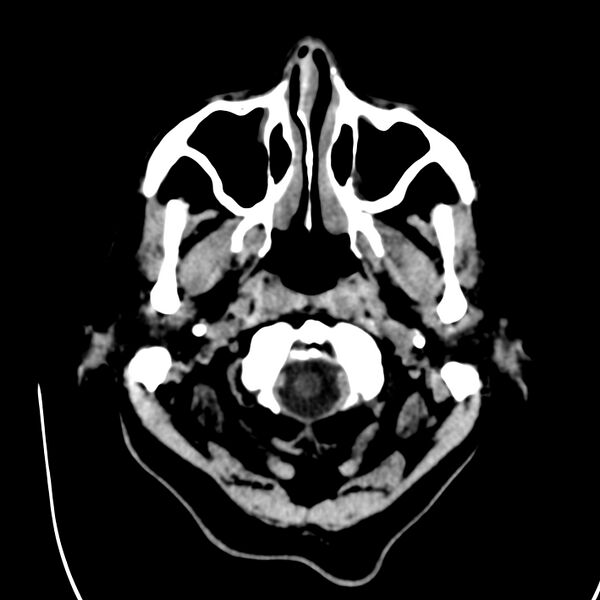 File:Brain Pantopaque remnants (Radiopaedia 78403-91048 Axial non-contrast 14).jpg