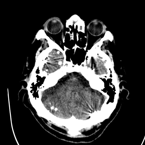 File:Brain Pantopaque remnants (Radiopaedia 78403-91048 Axial non-contrast 30).jpg