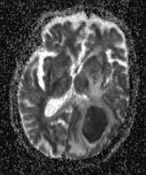 File:Brain abscess with dual rim sign (Radiopaedia 87566-103938 Axial ADC 10).jpg
