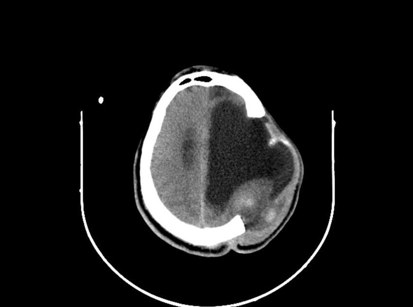 Brain injury by firearm projectile (Radiopaedia 82068-96088 A 163).jpg