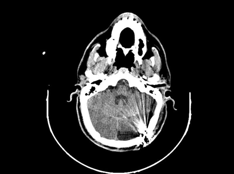 File:Brain injury by firearm projectile (Radiopaedia 82068-96088 A 85).jpg