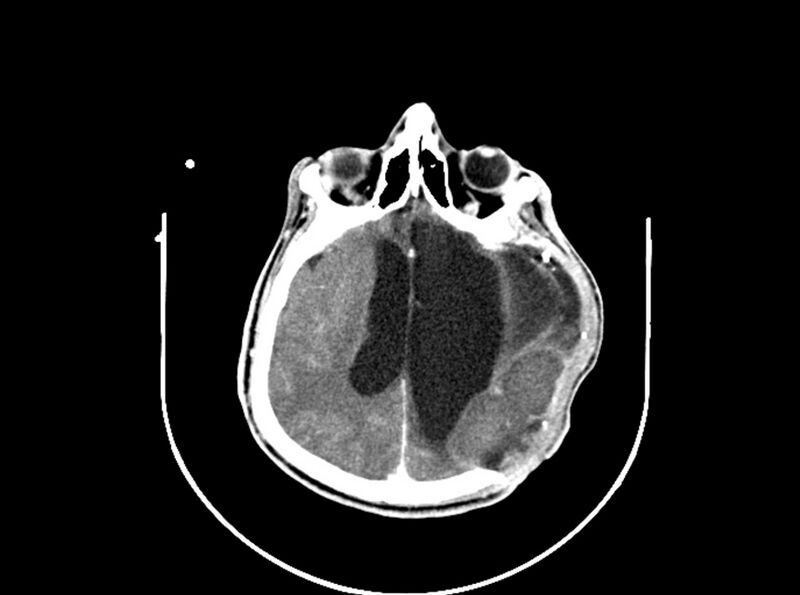 File:Brain injury by firearm projectile (Radiopaedia 82068-96088 B 137).jpg