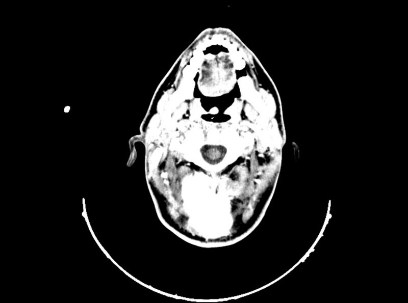 File:Brain injury by firearm projectile (Radiopaedia 82068-96088 B 53).jpg