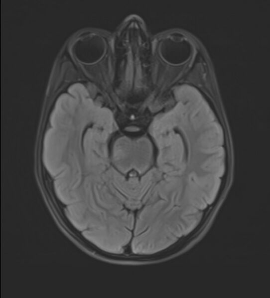 File:Brainstem glioma (Radiopaedia 70548-80674 Axial FLAIR 10).jpg