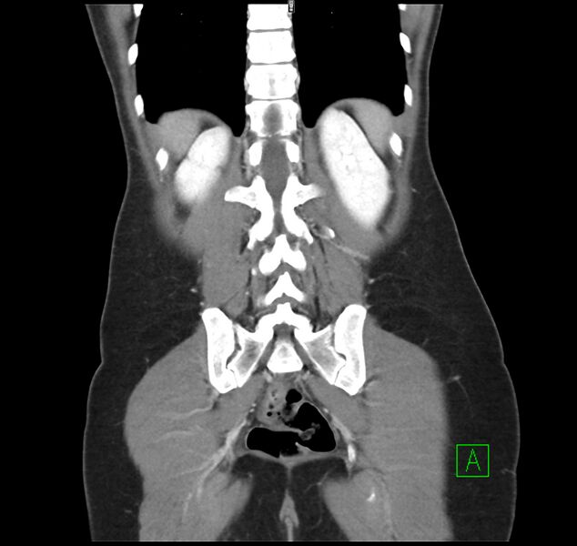 File:Broad ligament hernia (Radiopaedia 63260-71832 B 30).jpg
