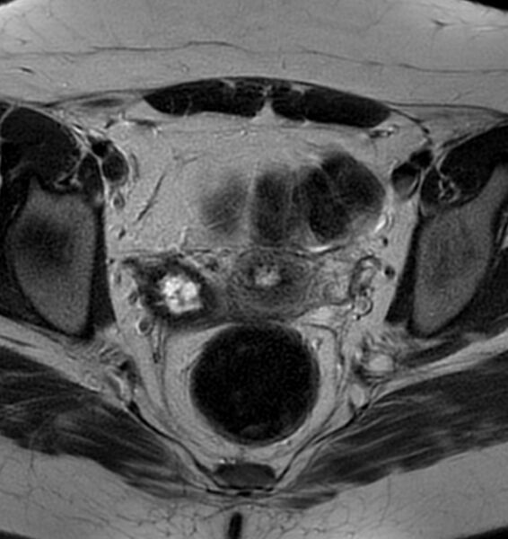 File:Broad ligament leiomyoma (Radiopaedia 81634-95516 Axial T2 15).jpg