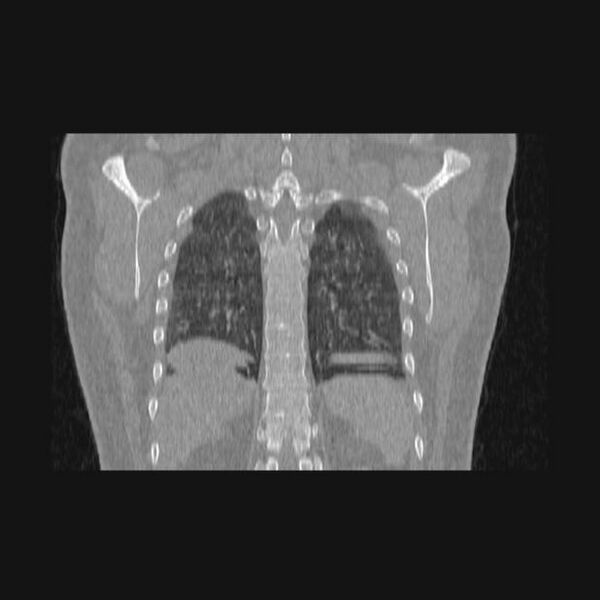 File:Bronchial atresia (Radiopaedia 60685-68439 Coronal lung window 16).jpg