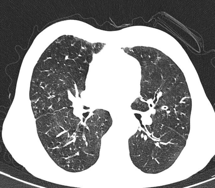 File:Bronchiolitis (Radiopaedia 24616-24887 Axial lung window 28).jpg