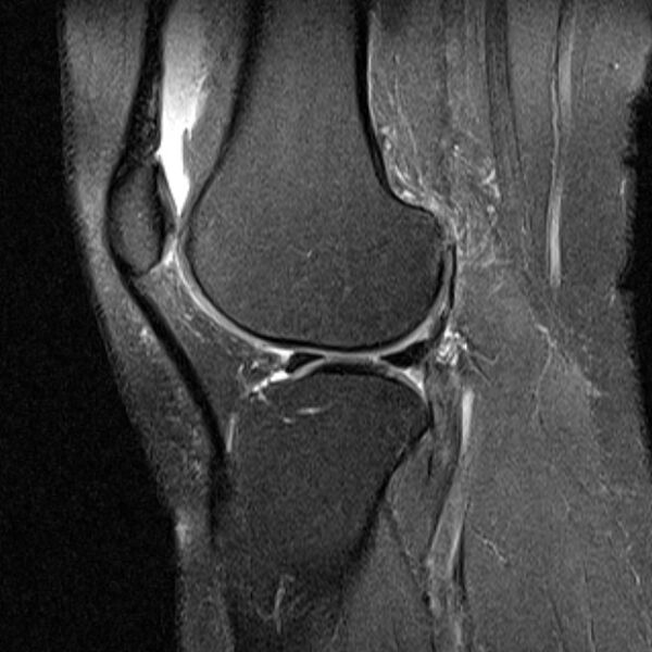 File:Bucket handle tear - medial meniscus (Radiopaedia 79028-91942 Sagittal PD fat sat 7).jpg