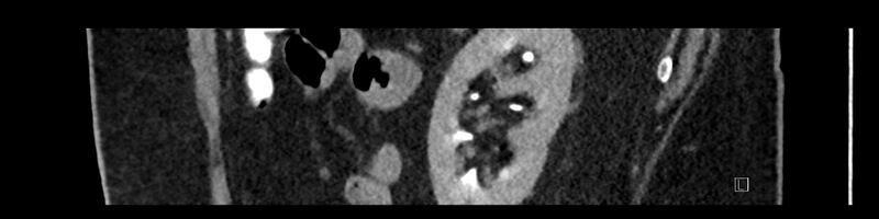 File:Buried bumper syndrome - gastrostomy tube (Radiopaedia 63843-72575 Sagittal Inject 31).jpg