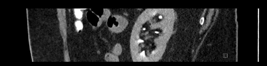 Buried bumper syndrome - gastrostomy tube (Radiopaedia 63843-72575 Sagittal Inject 31).jpg