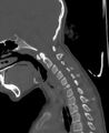 Butterfly vertebra (Radiopaedia 77903-90209 Sagittal bone window 38).jpg