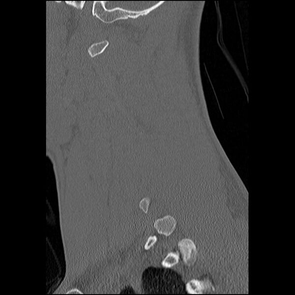 File:C5 facet fracture (Radiopaedia 58374-65499 Sagittal bone window 21).jpg