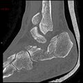 Calcaneal fracture and associated spinal injury (Radiopaedia 17896-17656 Sagittal bone window 6).jpg