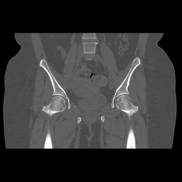 File:Calcific tendinitis of the gluteus medius muscle (Radiopaedia 66998-76318 Coronal bone window 26).jpg