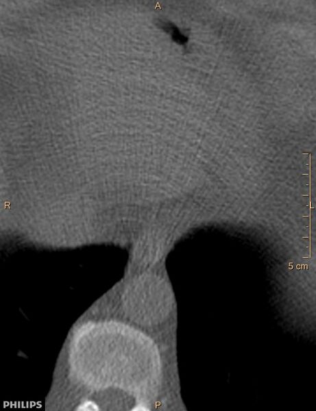 File:Calcified cardiac fibroma (Radiopaedia 39267-41519 Axial bone window 19).jpg