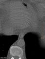 Calcified cardiac fibroma (Radiopaedia 39267-41519 Axial bone window 19).jpg