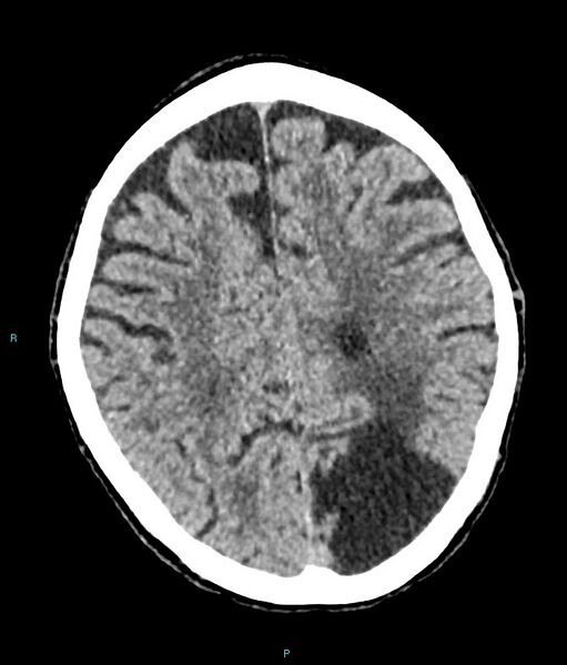 File:Calcified cerebral emboli from left ventricular thrombus (Radiopaedia 84420-99758 Axial non-contrast 32).jpg