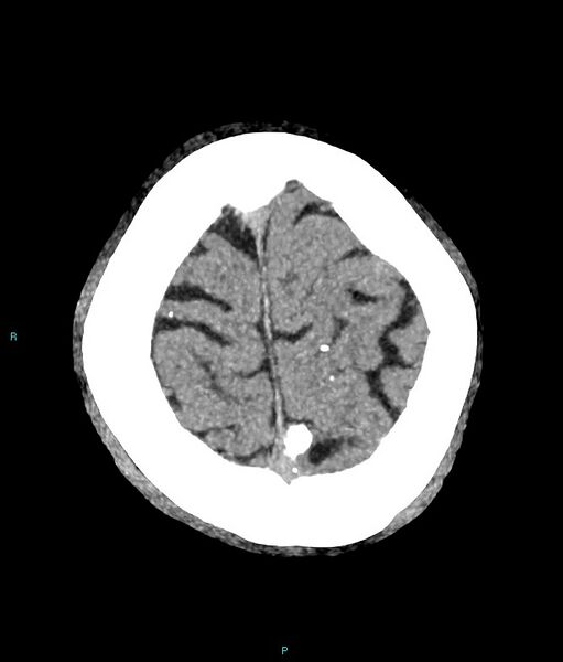 File:Calcified cerebral emboli from left ventricular thrombus (Radiopaedia 84420-99758 B 3).jpg