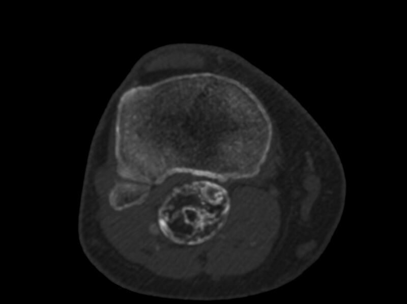 File:Calcified hematoma - popliteal fossa (Radiopaedia 63938-72763 C 55).jpg