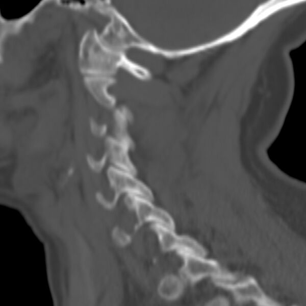 File:Calcified meningioma - cervical canal (Radiopaedia 70136-80171 Sagittal bone window 1).jpg