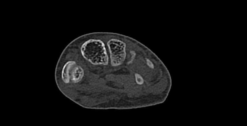 File:Calcifying aponeurotic fibroma (Radiopaedia 88423-105064 Axial bone window 121).jpg