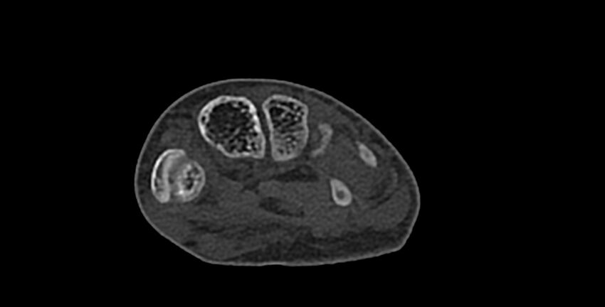 Calcifying aponeurotic fibroma (Radiopaedia 88423-105064 Axial bone window 121).jpg