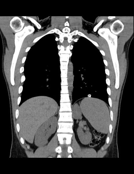 File:Calcifying pulmonary metastases (Radiopaedia 33359-34396 Coronal non-contrast 16).jpg