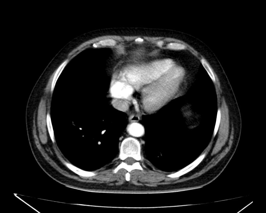 Carcinoid tumor with hepatic metastases (Radiopaedia 22651-22670 B 6).jpg