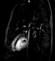 Cardiac hemangioma (Radiopaedia 16971-64065 Multiplanar 11).JPG