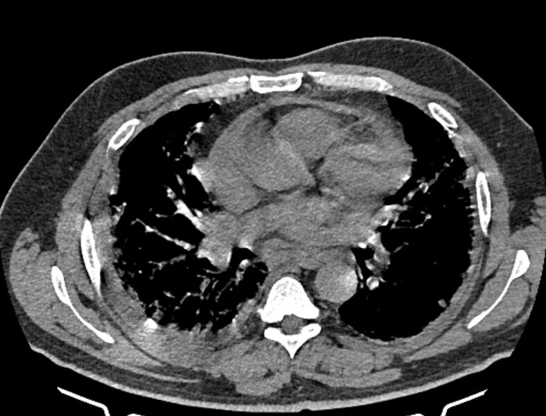 File:Cardiogenic pulmonary edema (Radiopaedia 68180-77678 Axial non-contrast 26).jpg