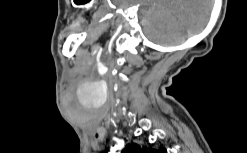File:Carotid artery pseudoaneurysm (Radiopaedia 84030-99259 E 30).jpg