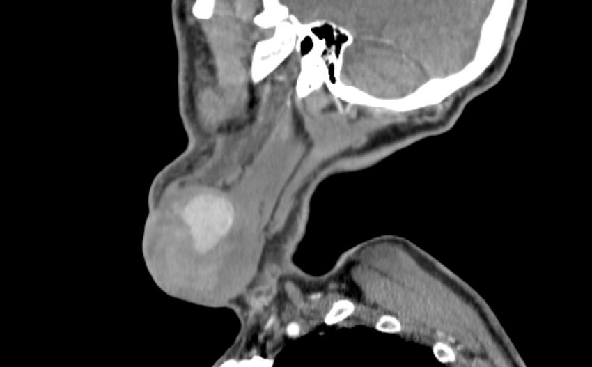 Carotid artery pseudoaneurysm (Radiopaedia 84030-99259 E 53).jpg