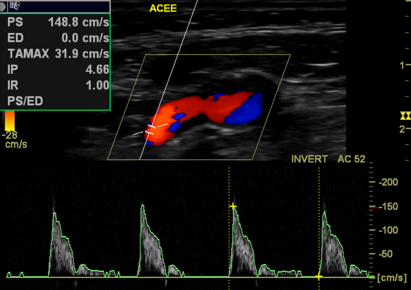File:Carotid artery stenosis (Radiopaedia 28786-29088 L 1).png